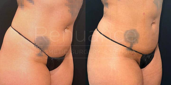 Renuance - renuvion skin tightening and liposuction by Jose Rodriguez, MD