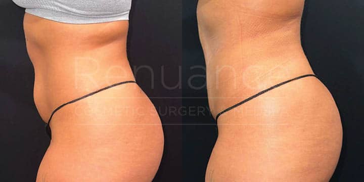 Renuance - renuvion skin tightening and liposuction by Jose Rodriguez, MD
