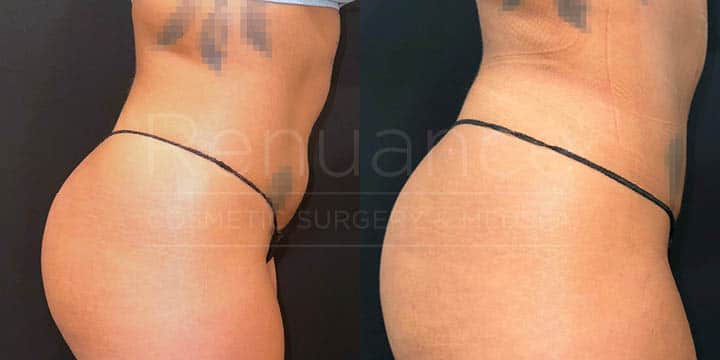 Renuance - renuvion skin tightening and liposuction by Jose Rodriguez, MD