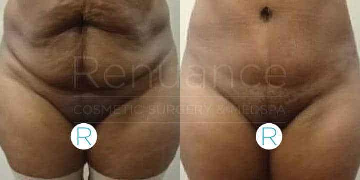 Renuance - tummy tuck by Jose Rodriguez, MD