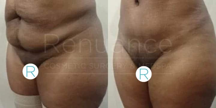 Renuance - tummy tuck by Jose Rodriguez, MD