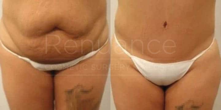 Renuance - tummy tuck by Jose Rodriguez, MD