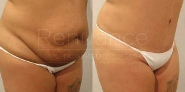 Renuance - tummy tuck by Jose Rodriguez, MD
