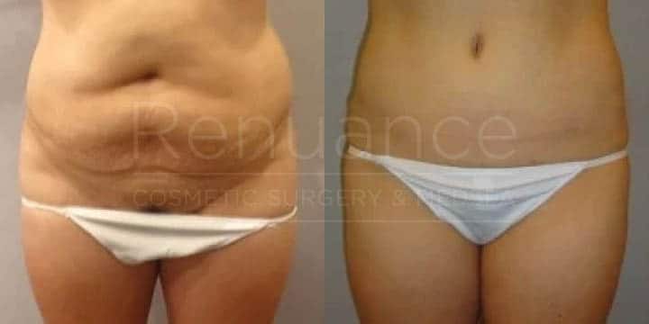 Renuance - tummy tuck by Jose Rodriguez, MD