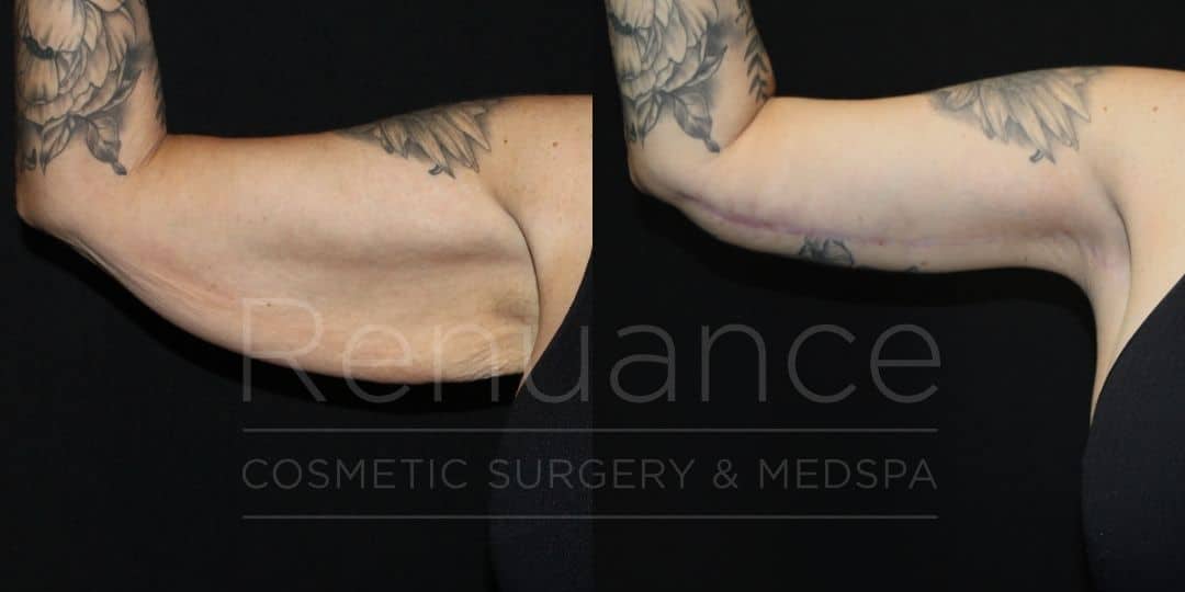 Renuance Dr Ford Brachioplasty