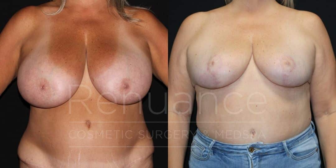 Renuance Dr Ford breast reduction