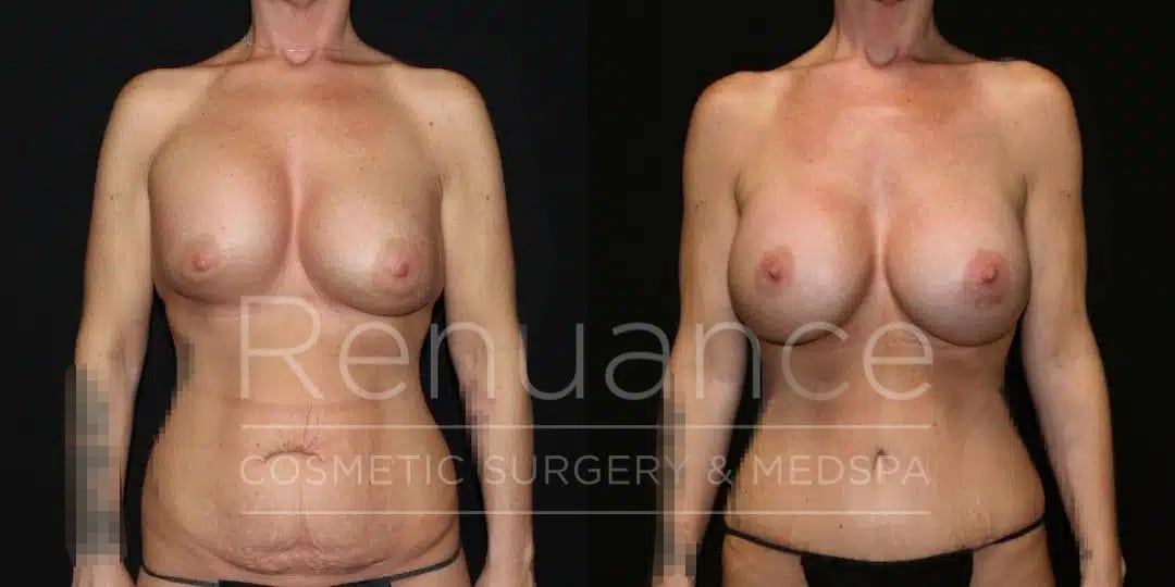 Renuance Dr Ford Mommy Makeover