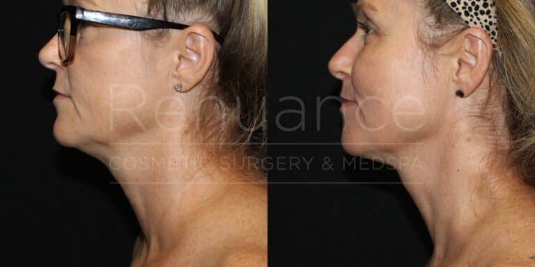Renuance Dr Ford Renuvion for lower face and neck