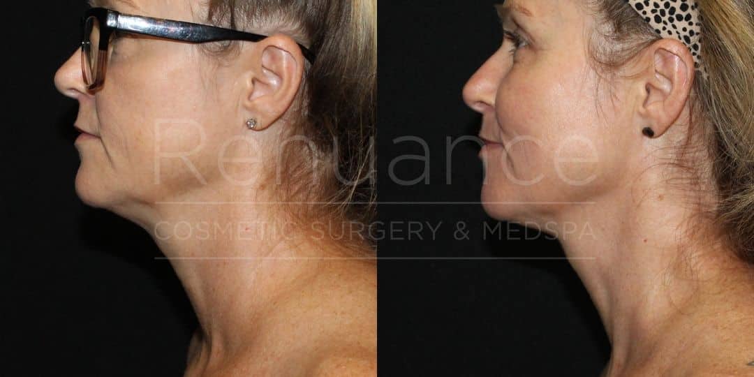 Renuance Dr Ford Renuvion for lower face and neck