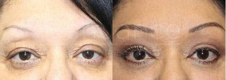 A side-by-side comparison of a woman's face before and after a cosmetic procedure. The left image shows the woman's face, where she has more pronounced wrinkles, sagging skin, and a tired appearance. In the right image, her face appears rejuvenated, with smoother skin, fewer wrinkles, and a more refreshed look. She has applied makeup, including foundation, eyeshadow, and eyeliner.