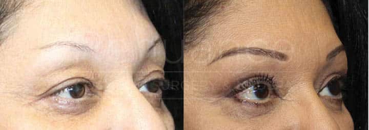 A side-by-side comparison of a woman's face before and after a cosmetic procedure. The left image shows the woman's face, where she has more pronounced wrinkles, sagging skin, and a tired appearance. In the right image, her face appears rejuvenated, with smoother skin, fewer wrinkles, and a more refreshed look. She has applied makeup, including foundation, eyeshadow, and eyeliner.