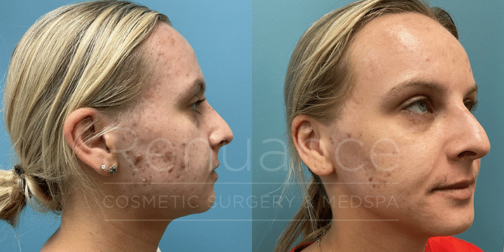 AdvaTX for acne laser treatment