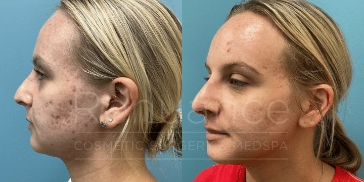 AdvaTX for acne laser treatment