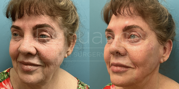 Cheek Filler before and after