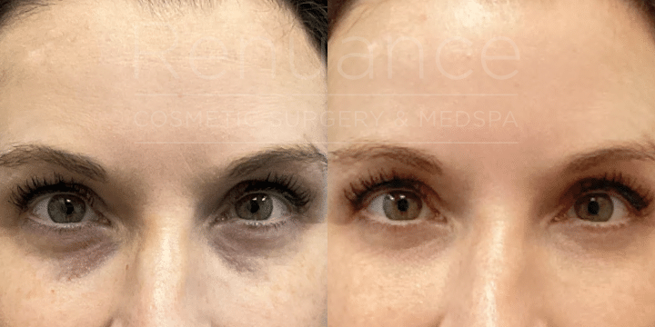 EZ PRF Gel 1 Tx under eyes