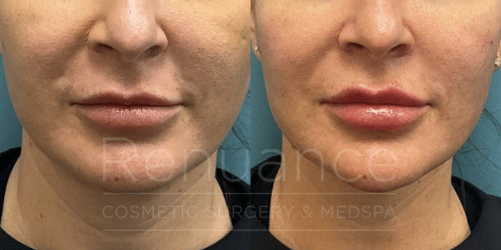 ChelseaDelaneyRN.LipFiller.Patient3