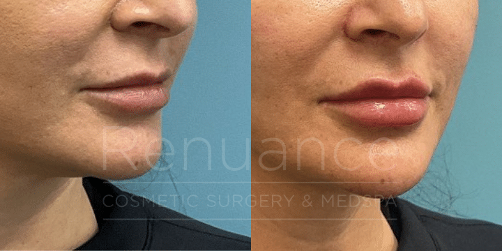 ChelseaDelaneyRN.LipFiller.Patient3_2