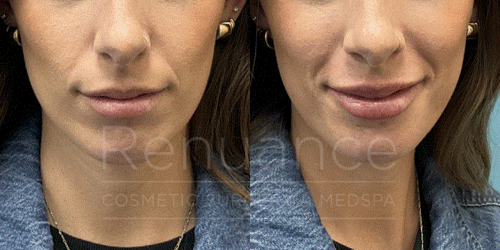 ChelseaDelaneyRN.LipFiller