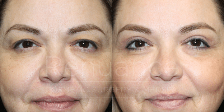 Dr.Ford-Upper blepharoplasty