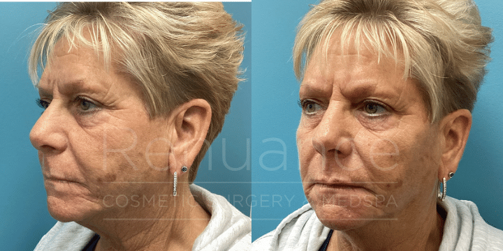 Dermal Filler before and after