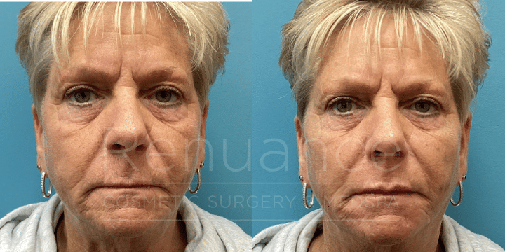 Dermal Filler treatment for a woman over 50 years old