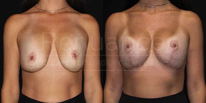 Renuance - Implant Exchange and Breast Lift by Dr Ford