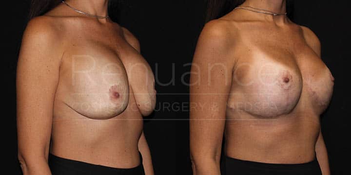 Renuance - Implant Exchange and Breast Lift by Dr Ford