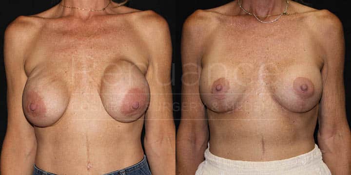 Renuance - Implant Exchange, Capsulectomies, Plane Change to Subpectoral, Mesh, and Breast Lift for Capsular Contracture by Dr Ford