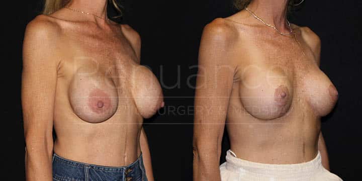 Renuance - Implant Exchange, Capsulectomies, Plane Change to Subpectoral, Mesh, and Breast Lift for Capsular Contracture by Dr Ford