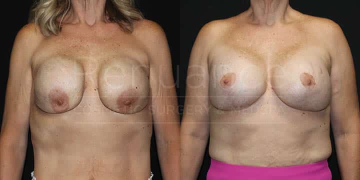 Renuance - Implant Exchange, Plane Change to Subpectoral, Mesh, Breast Lift by Dr Ford