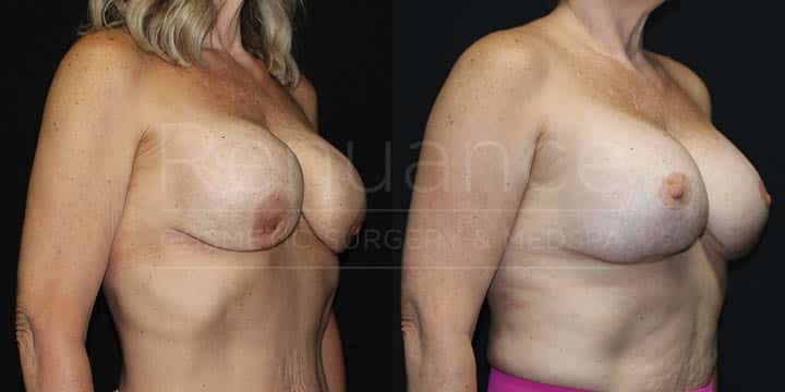 Renuance - Implant Exchange, Plane Change to Subpectoral, Mesh, Breast Lift by Dr Ford