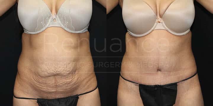 Renuance - Tummy Tuck by Dr Ford
