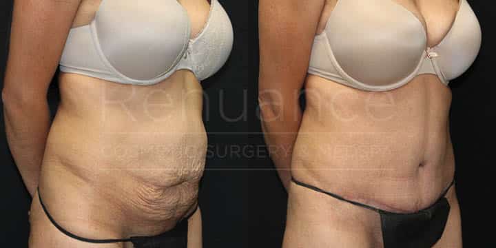 Renuance - Tummy Tuck by Dr Ford