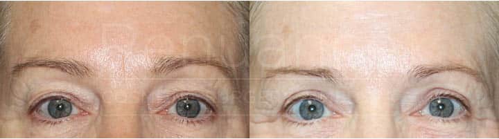 Renuance - Upper Blepharoplasty - Eyelid Lift by Dr Ford