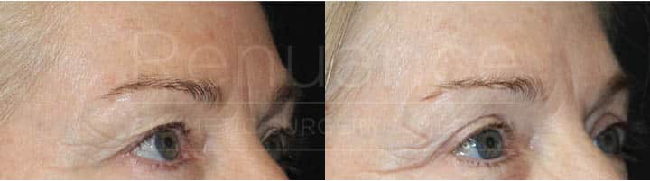 Renuance - Upper Blepharoplasty - Eyelid Lift by Dr Ford