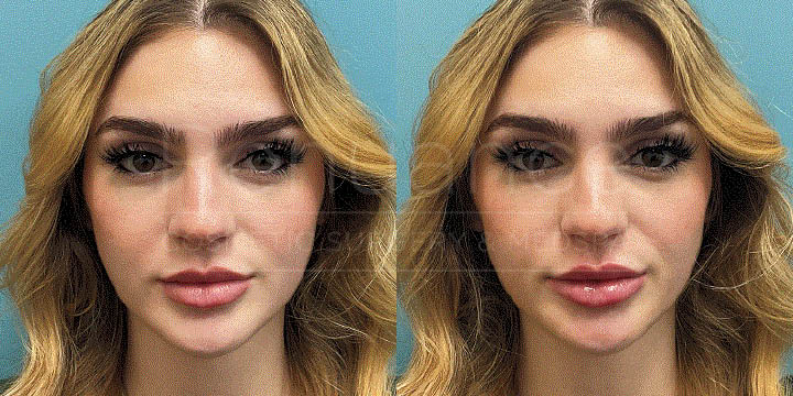 Renuance - Lip filler by Chelsea Delaney, RN