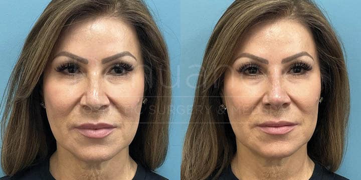 Renuance - Nose filler by Chelsea Delaney, RN