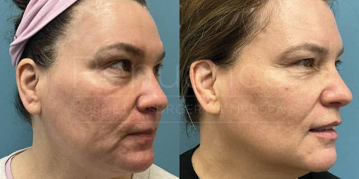 Renuance - CO2 Session by Chelsea Delaney, RN