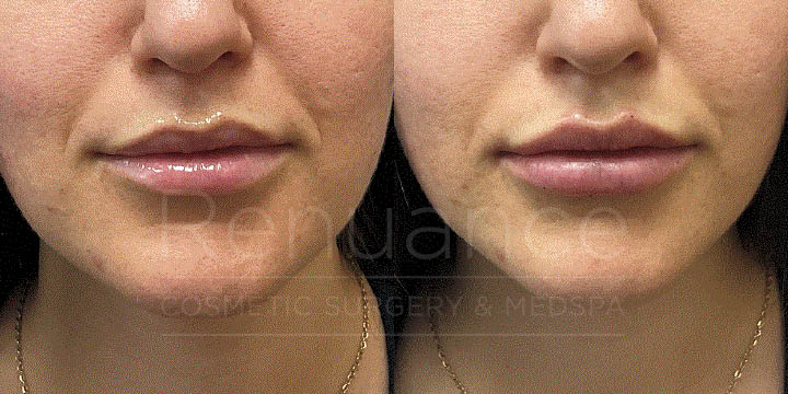 Renuance - Lip filler by Chelsea Delaney, RN