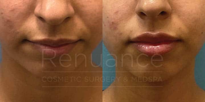 Renuance - Lip filler by Chelsea Delaney, RN