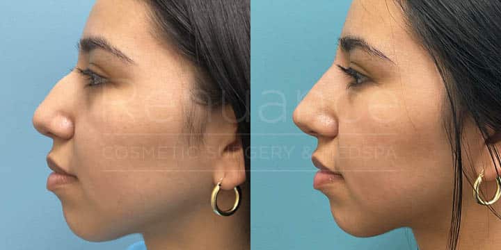 Renuance - Nose filler by Chelsea Delaney, RN
