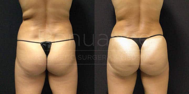 Renuance - BBL Vaser by Michael Hill, MD