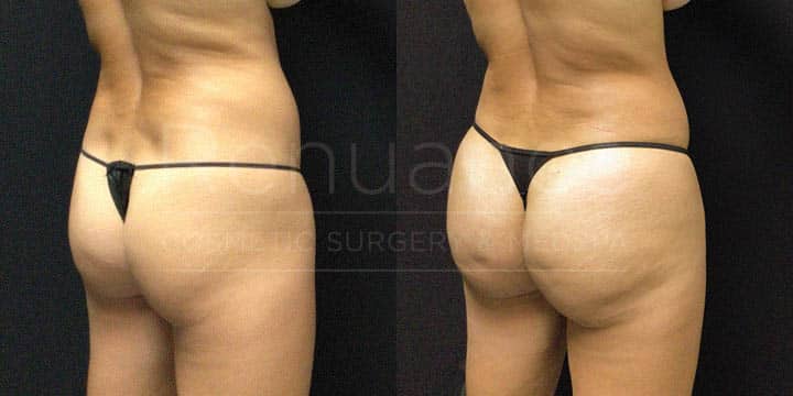 Renuance - BBL Vaser by Michael Hill, MD