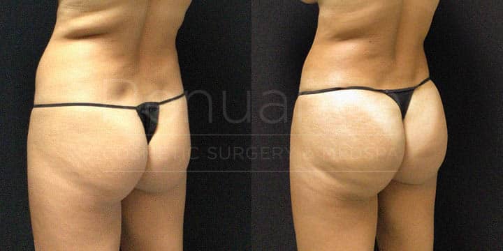 Renuance - BBL Vaser by Michael Hill, MD