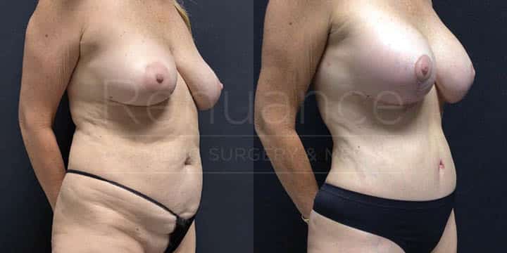 Renaunce - Mommy Makeover - Tummy Tuck, Vaser360, Breast Augmentation, Liposuction by Michael Hill MD