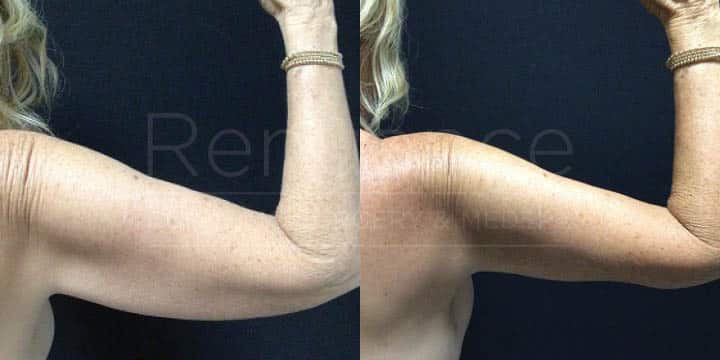 Renaunce - Mommy Makeover - Tummy Tuck, Vaser360, Breast Augmentation, Liposuction by Michael Hill MD