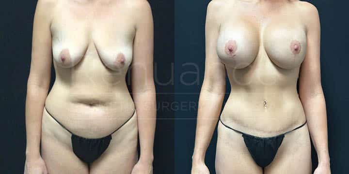Renuance - Mommy Makeover - Tummy Tuck, Liposuction, Breast Augmentation by Michael Hill MD