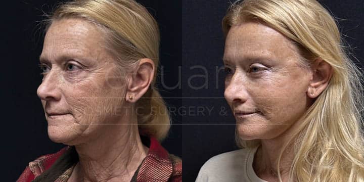 Renuance - Quad Blepharoplasty, Facelift, Neck Lift, Brow Lift, Lip Lift - 6wks Post-Op by Michael Hill MD