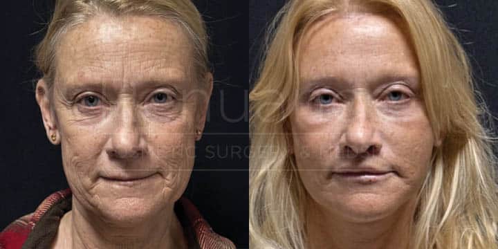 Renuance - Quad Blepharoplasty, Facelift, Neck Lift, Brow Lift, Lip Lift - 6wks Post-Op by Michael Hill MD