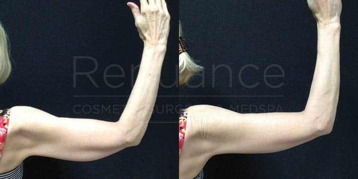 Renuance - Brachioplasty by Michael Hill, MD